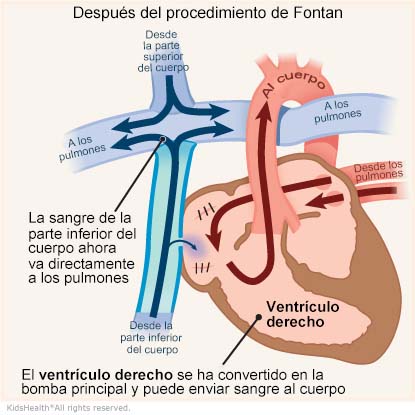 Una ilustración muestra el ventrículo derecho después del procedimiento de Fontan