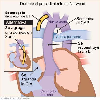 Una ilustración muestra el procedimiento de Norwood