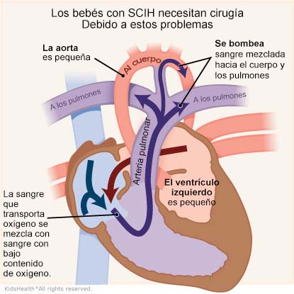 Una ilustración muestra el síndrome del corazón izquierdo hipoplásico