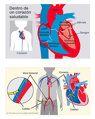 Una ilustración muestra el cateterismo cardíaco en un niño