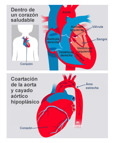Una ilustración muestra la coartación de la aorta en bebés