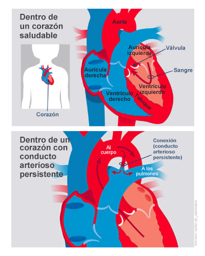 Una ilustración muestra el corazón de un niño con conducto arterioso persistente