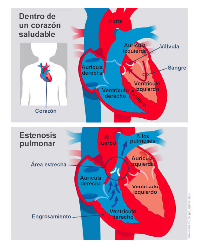 Un diagrama muestra la estenosis congénita de la válvula pulmonar en comparación con el corazón de un niño sano