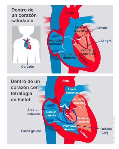 Diagrama que muestra las diferencias entre un corazón sano y uno con tetralogía de Fallot.