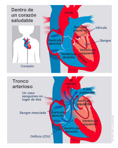 Los niños con tronco arterioso nacen con una sola arteria grande que lleva sangre a los pulmones y al cuerpo en lugar de dos arterias separadas.